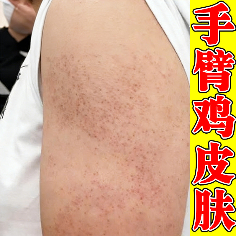 手臂鸡皮疙瘩外用乳膏腿上疙瘩起小颗粒疙瘩摸起来粗糙
