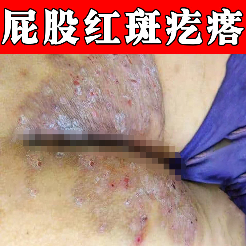 屁股红斑疙瘩干燥粗糙起皮专用膏屁股长痘痘痒起热疙瘩大腿内侧痒