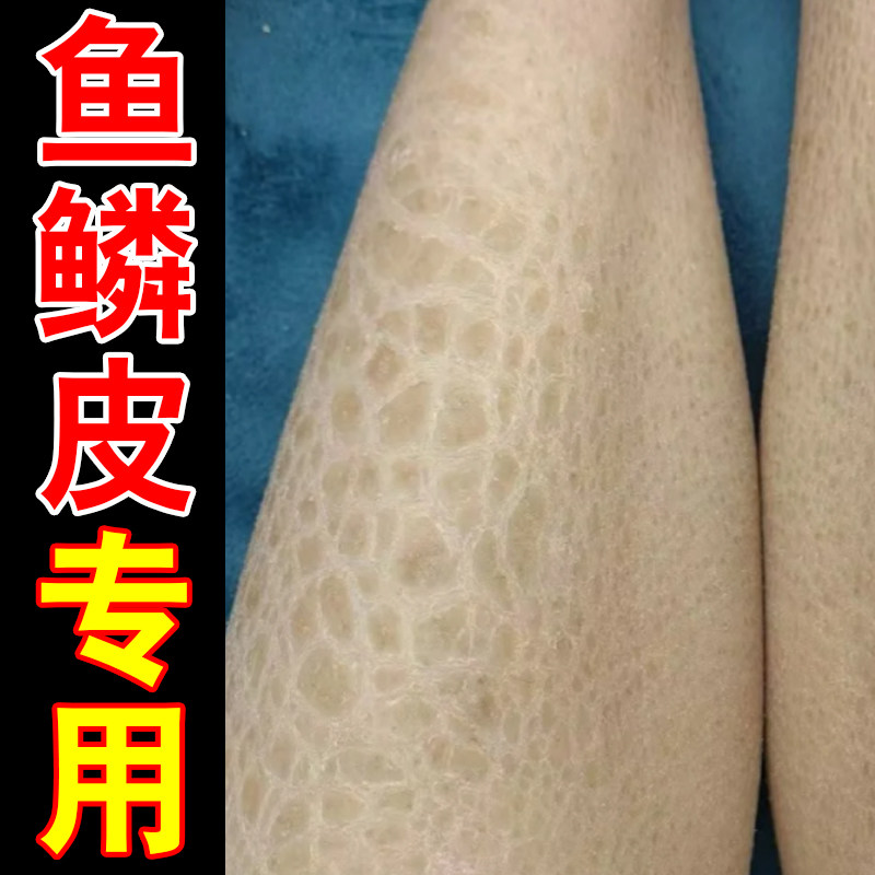 鱼鳞皮专用修复补水保湿甘油小腿皮肤干燥粗糙起块状干皮起皮掉屑
