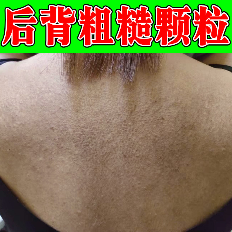后背粗糙颗粒色素沉淀改善皮肤干燥增厚发痒长硬疙瘩小颗粒专用膏