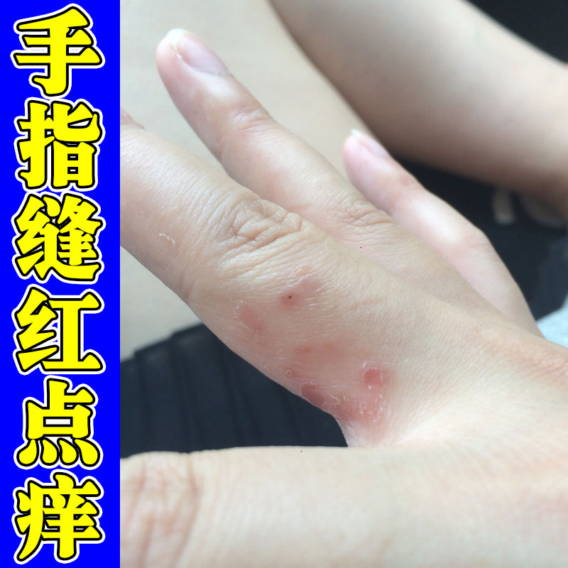 手指缝长小红点疙瘩痒换季手起皮脱皮手长小水泡指缝红痒干燥粗糙