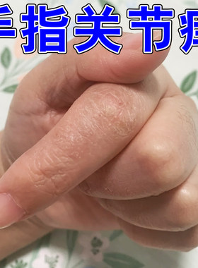 手指关节痒干裂粗糙真菌手起皮脱皮起硬疙瘩手痒专用修复软膏