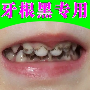 牙斑净牙缝发黑清理神器牙根黑黑的牙结石牙垢口臭牙齿发黑