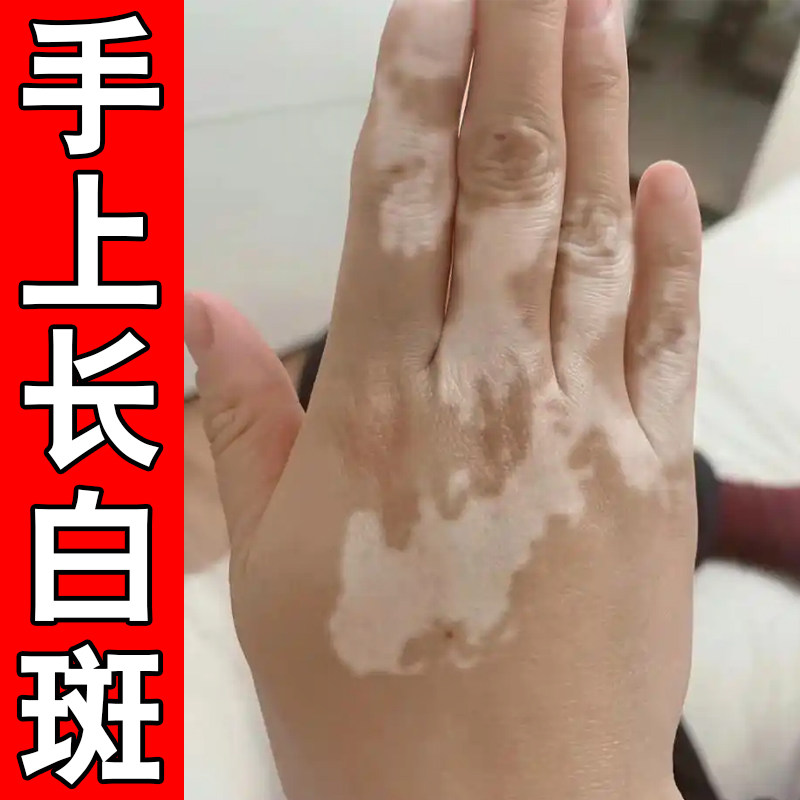 手上长白斑手指有白色斑块男女专用修复促进黑色素生长外用膏