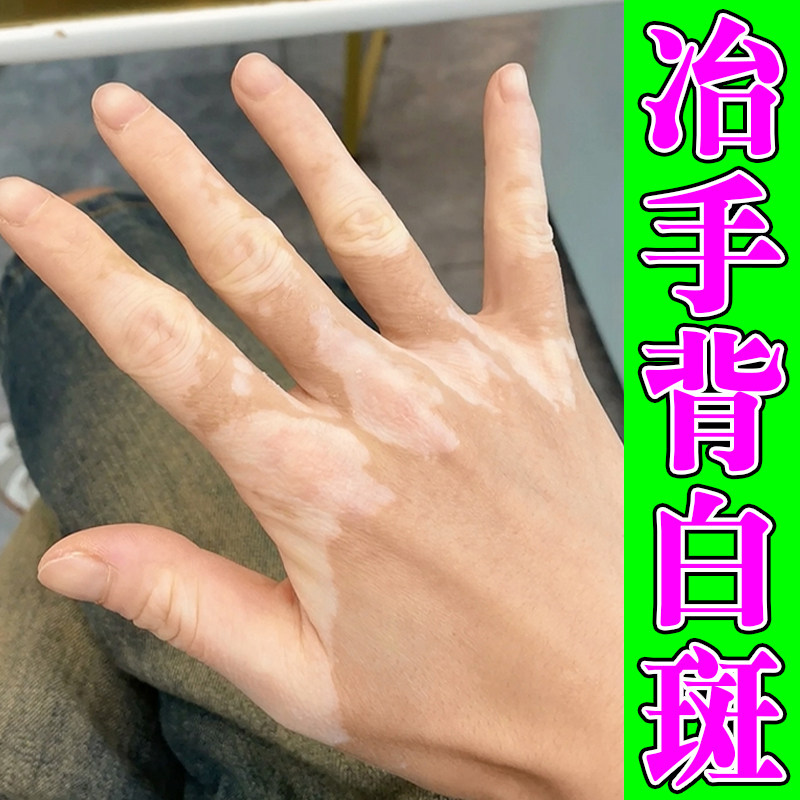 冶手背白斑的药修复促进黑色素生长补骨脂酊专用手上身上长白斑块