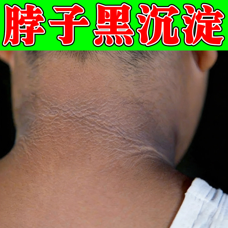 去脖子黑色素沉淀儿童除胳膊肘膝盖关节黑棘皮洗不干净专用按摩膏