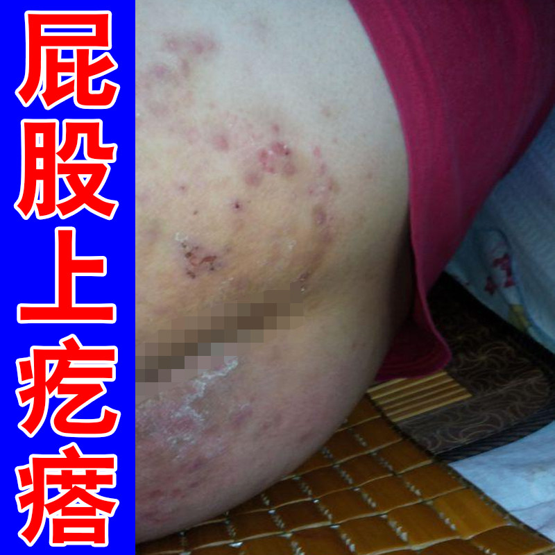 屁股上长痘痘痒起热疙瘩药臀部皮肤干燥粗糙起红斑股屁股痘专用膏