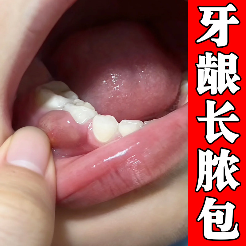 牙龈长脓包专用修复药牙周红肿疼痛脓液溢出牙根鼓包肿包喷雾剂