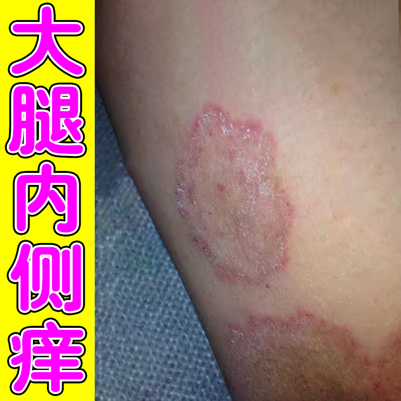 大腿内侧皮肤痒真菌感药股男士阴囊潮湿私处红斑干痒痒长小疙瘩膏