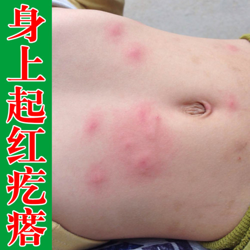 身上起疙瘩痒身上起小点痒男女通用儿童老人喷剂
