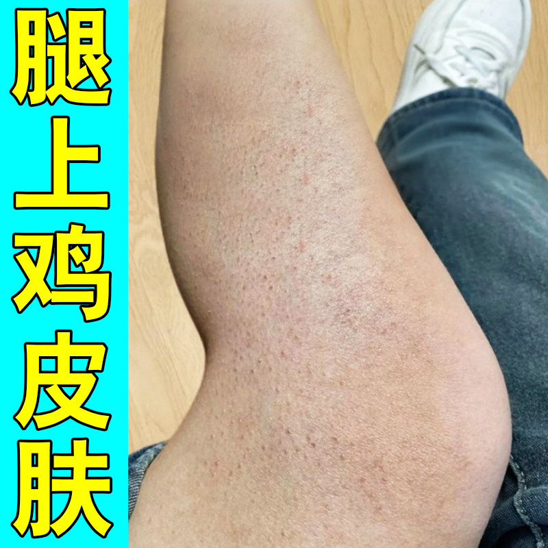 腿上鸡皮疙瘩专用膏小腿手臂密密麻麻小颗粒毛囊堵塞毛周角化症药