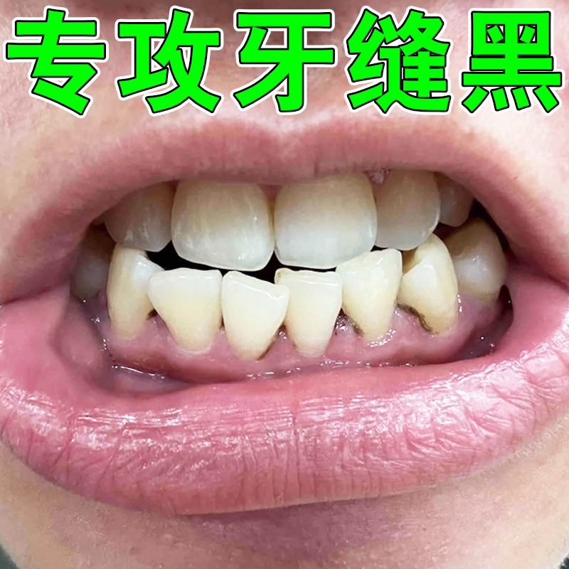 牙斑净去牙缝发黑清理神器牙菌斑洗污垢祛除黄牙擦烟茶渍色素沉淀