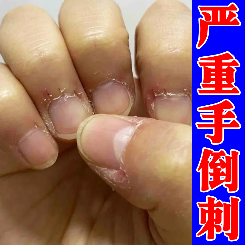 手指头起倒刺干燥粗糙起皮掉屑指甲边缘起死皮肉刺手倒刺外用软膏