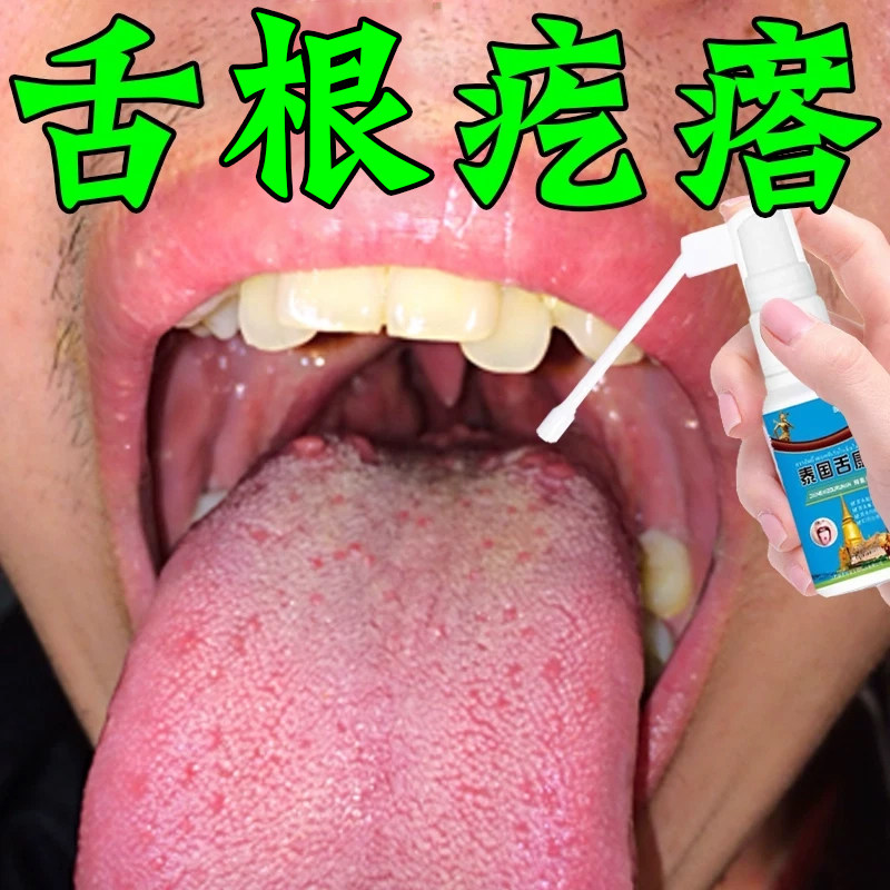 舌根长疙瘩小肉球喉咙滤泡增生吞咽有异物肿痛舌裂纹修复草本喷剂