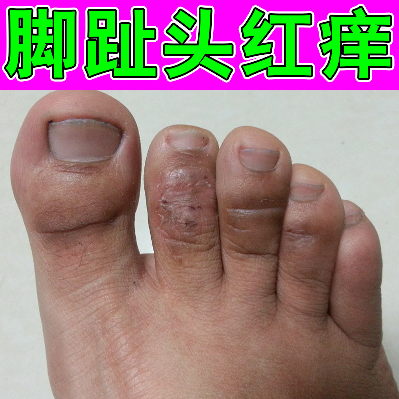 脚趾头红痒专用干燥粗糙起皮掉屑长小红点干裂换季手脚脱皮干痒药