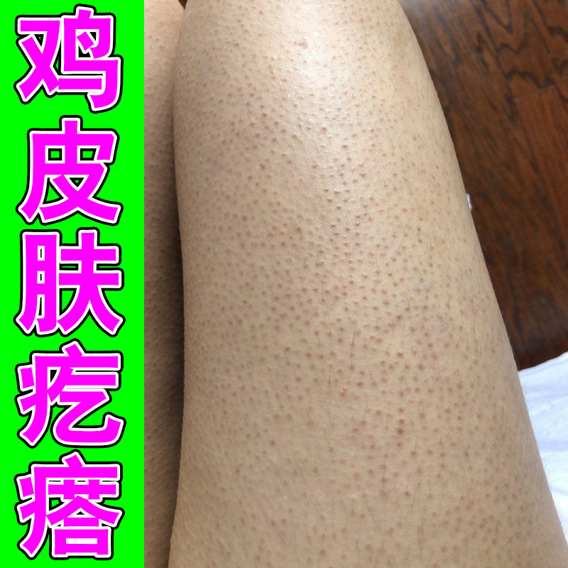 鸡皮疙瘩毛囊堵塞腿上粗糙小颗粒皮肤凸起小黑点腿部大腿小疙瘩药