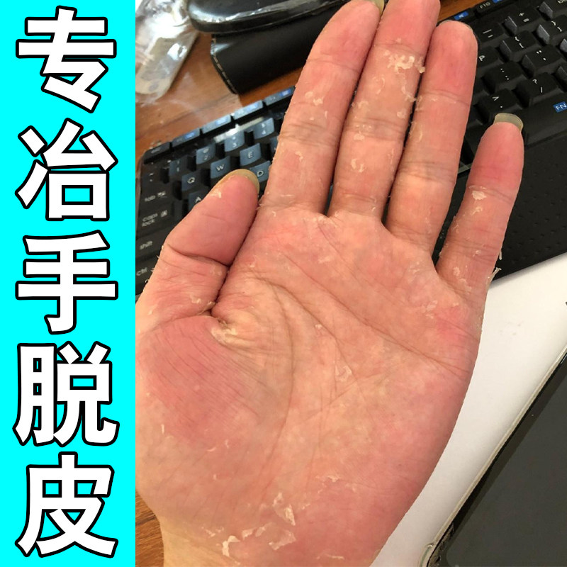 专冶手脱皮专用真菌手掌心严重蜕皮干燥粗糙手指头脱皮起皮掉皮药