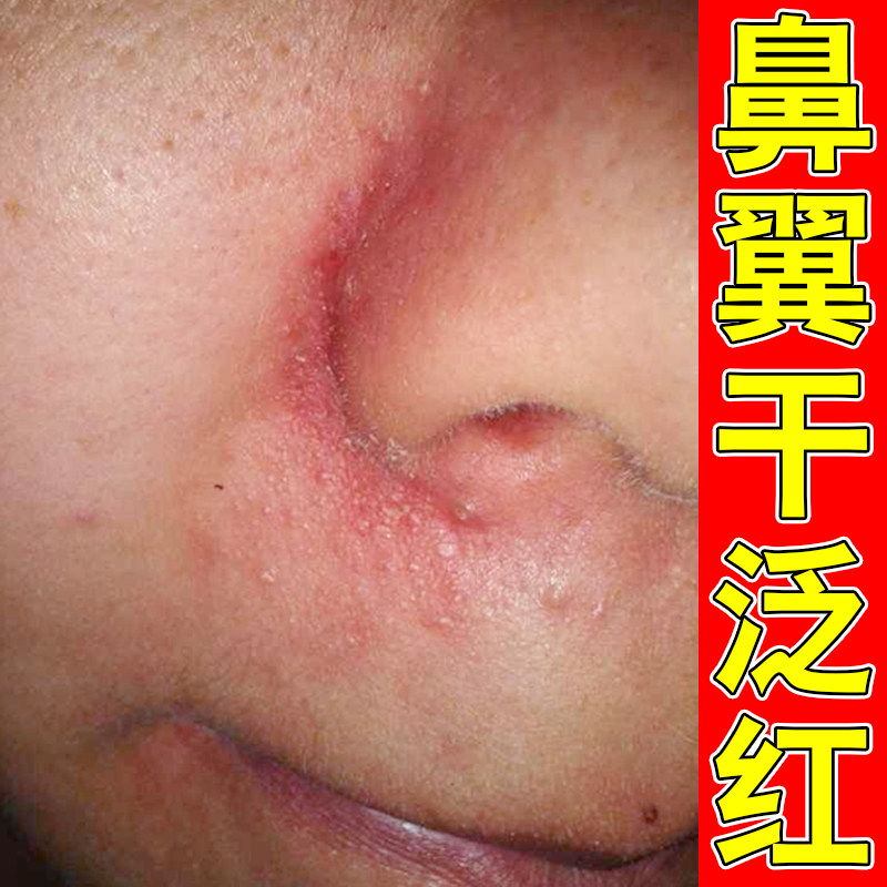 鼻子两侧发红掉皮鼻翼两边泛红干燥起皮小疙瘩去螨虫药软膏