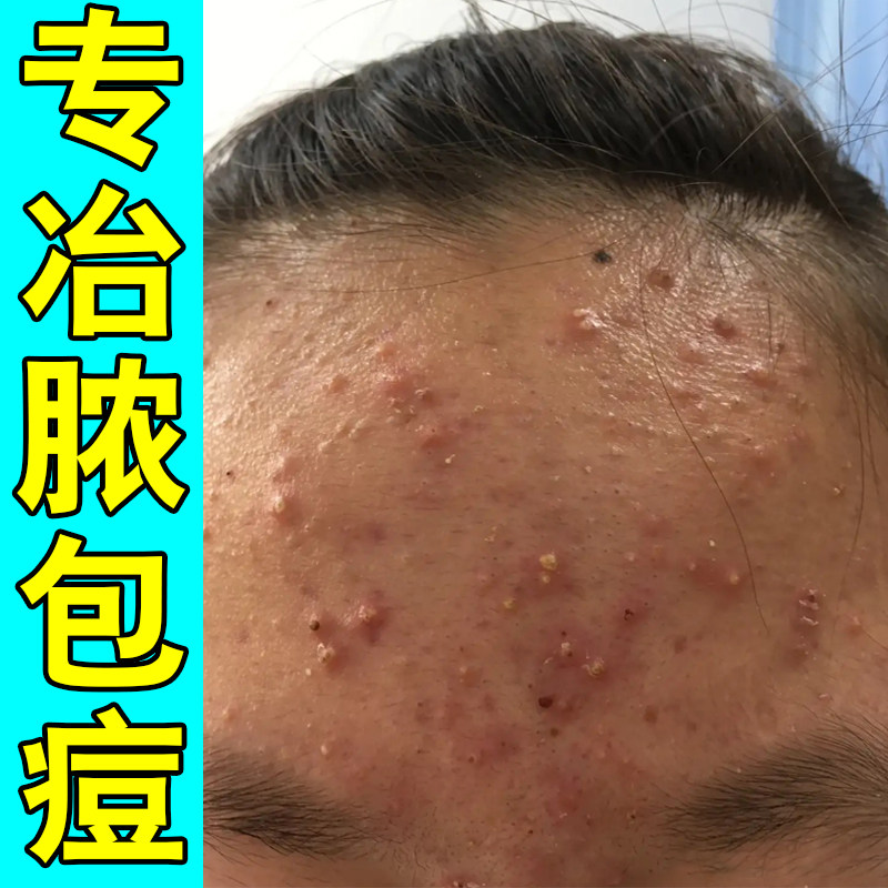 专冶脸上额头痘的药脓包红肿痘上火长痘闭口粉刺小疙瘩痘
