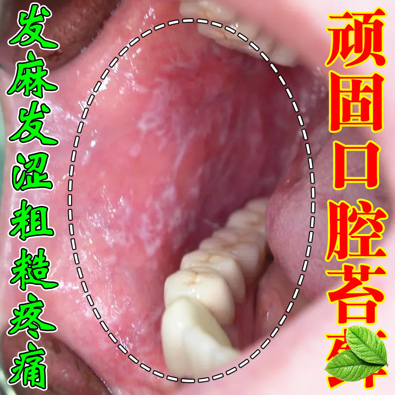 口腔扁平苔地图舌发白黏膜口腔粘膜修复液喷雾灼口综合症