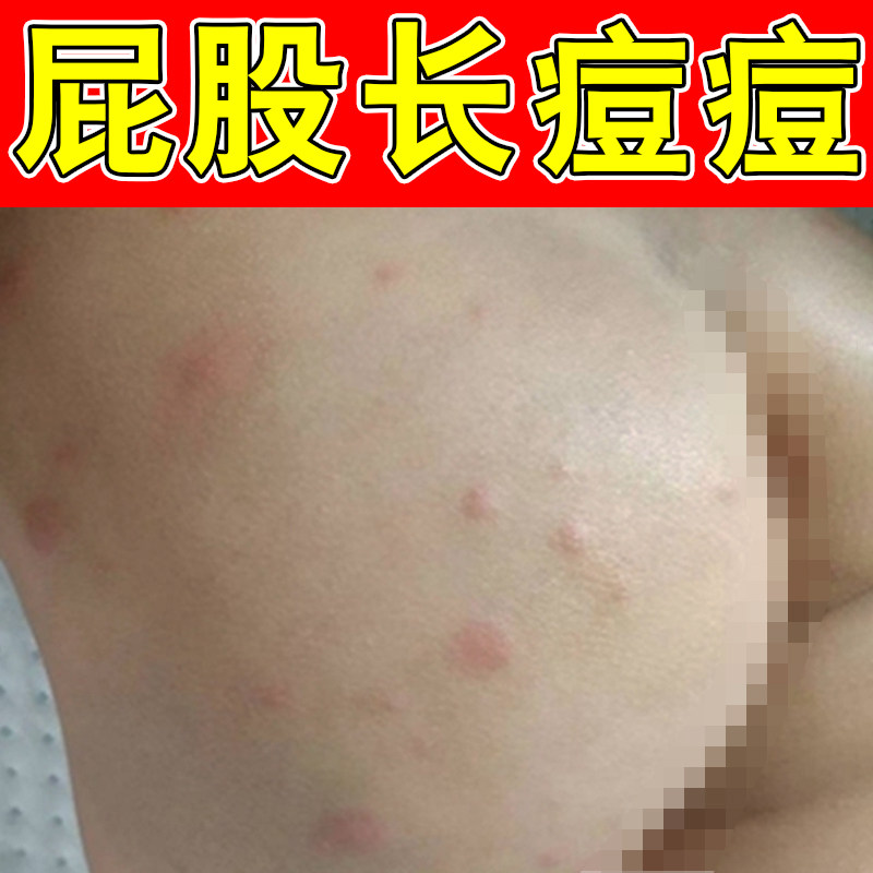 屁股长痘痘专用软膏冶大人屁股痘痘臀部起热疙瘩股痒火疖子修复药