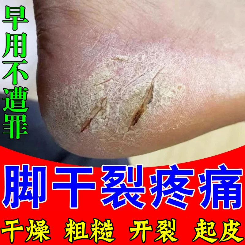 脚后跟干裂修复霜角化鳞屑起硬皮足跟开裂干燥粗糙起皮掉屑脚脱皮