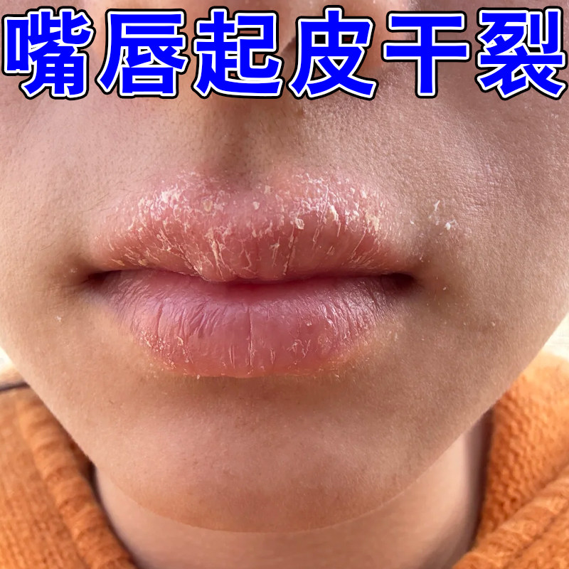 嘴巴干燥起皮药嘴角起干屑嘴唇紧绷起皮唇周发干呵护唇部补水保湿