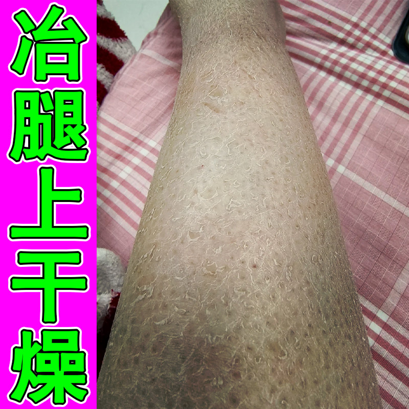 冶腿上干燥粗糙起皮掉屑腿部皮肤干燥外用修复小腿鱼鳞蛇皮肤干皮