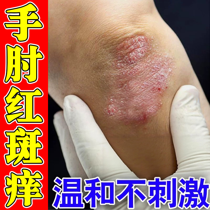 手肘痒药胳膊肘关节长红斑疙瘩神经性皮肤干燥粗糙起皮掉屑痒软膏