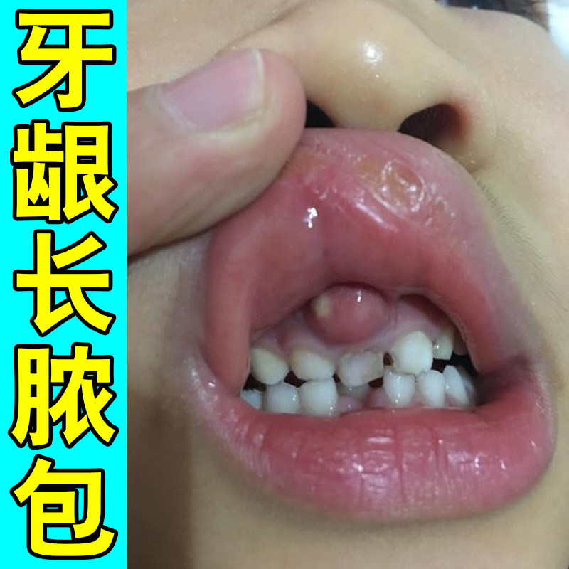牙龈脓包肿痛专用牙根上火红肿鼓包儿童成人牙龈不适感染肿包药
