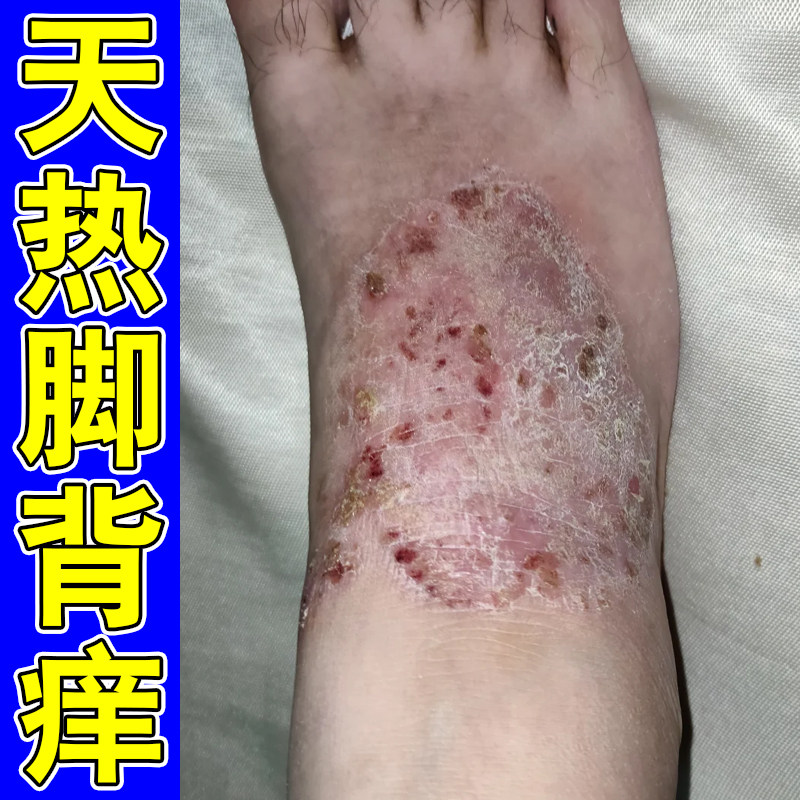 天热脚背痒脚上起干皮起红斑疙瘩干燥粗糙痒换季脚面痒外用软膏