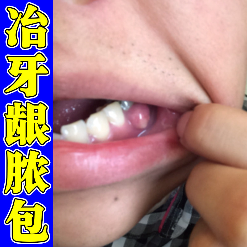 冶牙龈脓包的药疼痛软疙瘩牙根长肿包红肿不适发热专用修复喷剂