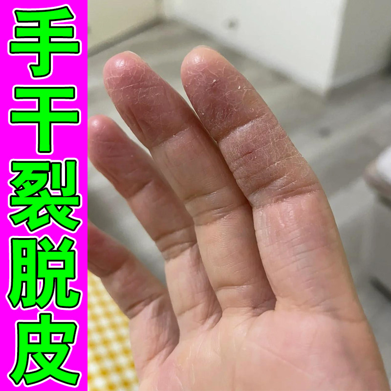 手干裂脱皮修复霜手指头起皮掉皮去死皮季节性手足蜕皮干燥痒软膏