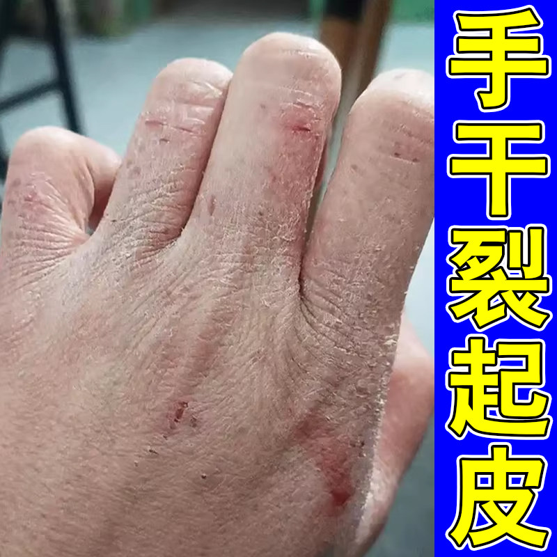 手干裂修复霜起皮掉屑裂口干痒药疼痛季节手脱皮掉皮手干燥粗糙膏