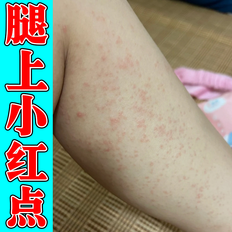 身上红疙瘩过敏皮肤痒专用冶皮肤痒的药小腿痒起风团痘痘干痒软膏
