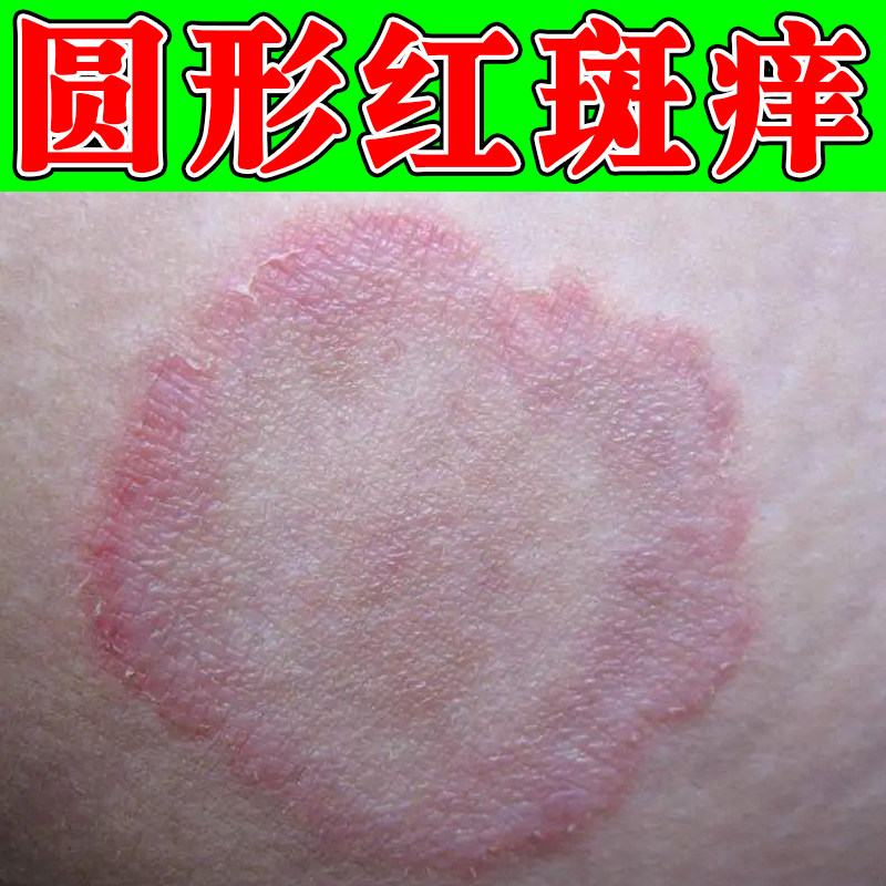 铜钱圆形红斑痒皮肤干燥粗糙起皮掉屑真菌猫圆圈身上长疙瘩痒软膏