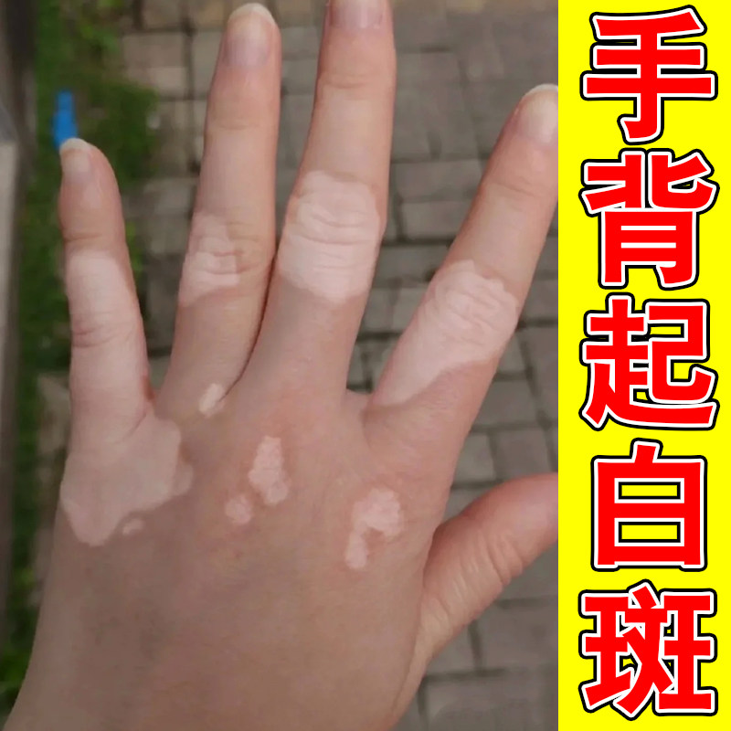 手背起白斑外用促进黑色素生长补骨脂酊肤色不均手上有白点
