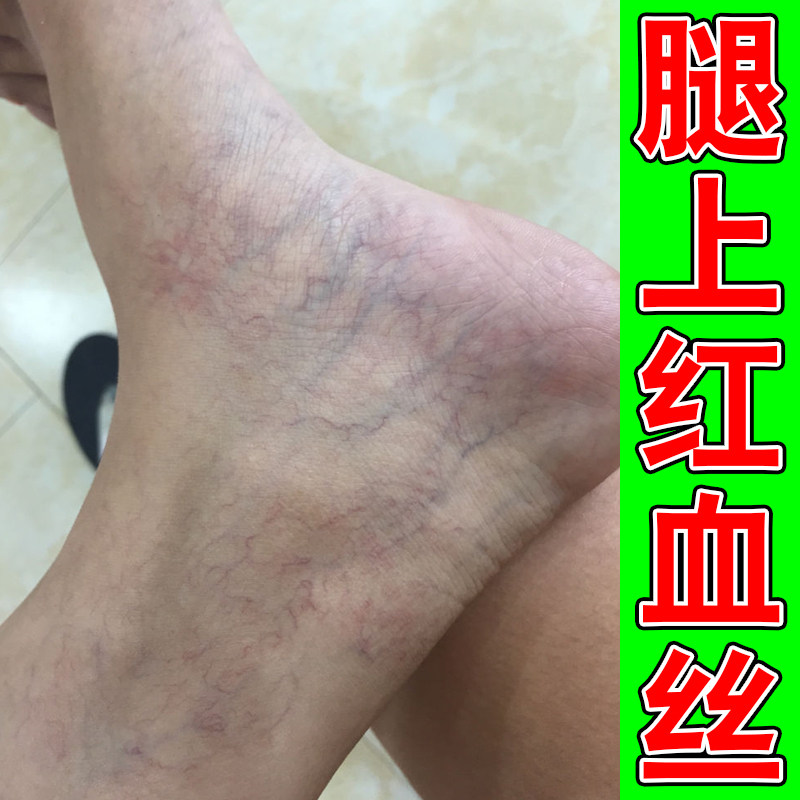 腿上红血丝青筋凸起久站久坐腿部酸胀沉重血丝腿男女修复冷敷凝胶