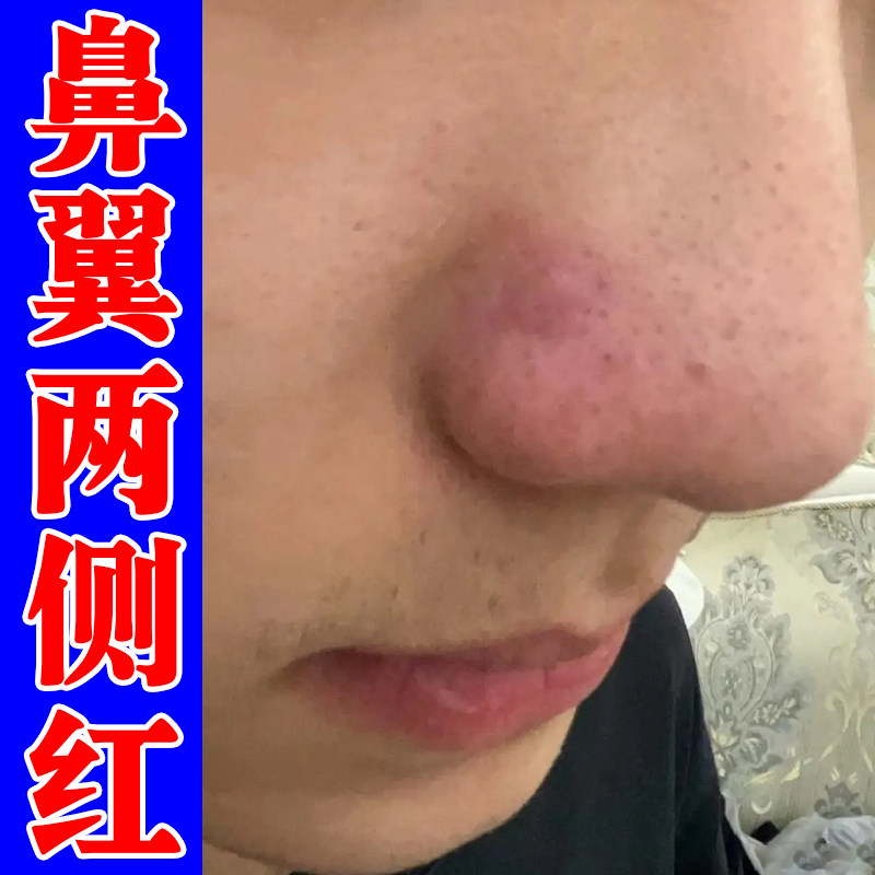 鼻翼两侧泛红长小疙瘩鼻头红溢脂性鼻子皮肤过敏干痒外用修复软膏