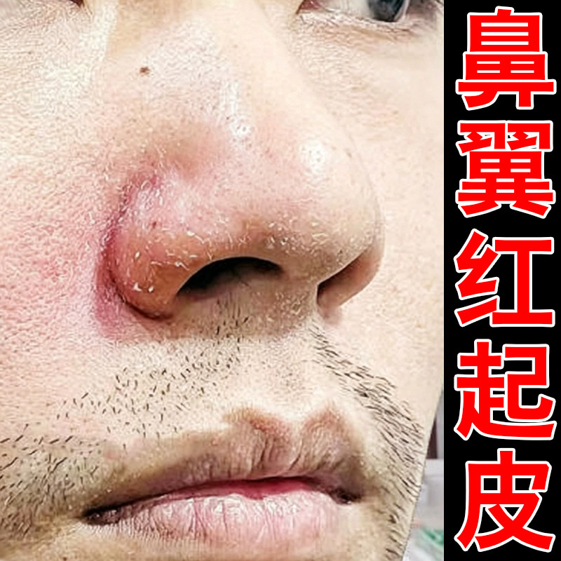 鼻翼发红起皮掉皮干燥粗糙鼻子两侧泛红干痒酒槽鼻红鼻头修复软膏