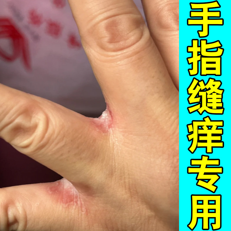 手指缝痒专用软膏指缝泛白发红长小水泡疙瘩干燥粗糙真菌脱皮手痒