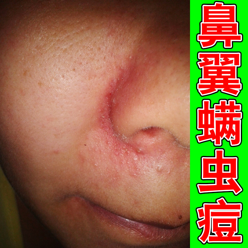 鼻翼两侧泛红长小疙瘩螨虫痘油腻鼻子干燥粗糙起皮掉屑外用修复膏