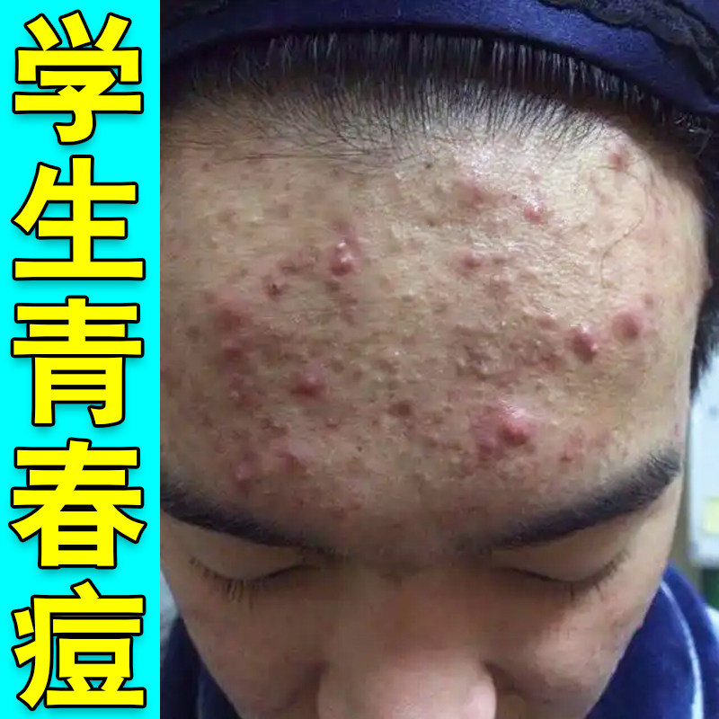 学生青春痘额头长脓包疙瘩内分泌失调下巴长痘痘红疙瘩外用软膏