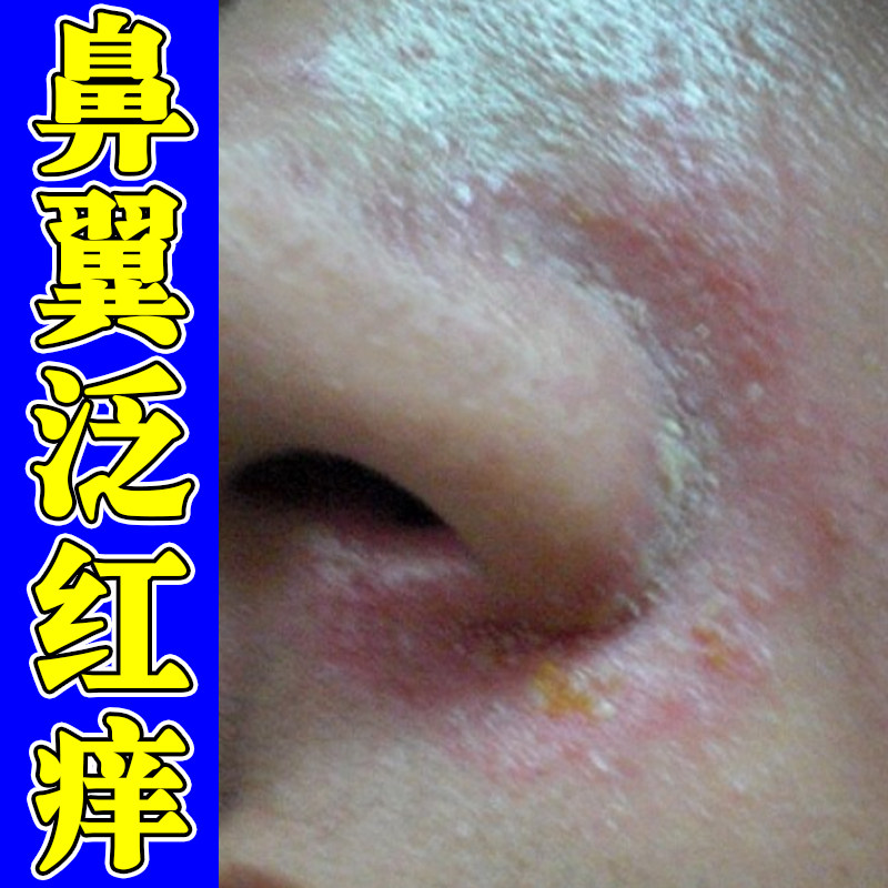 鼻翼两侧泛红修复溢脂性鼻子两边发红干痒起皮掉屑红鼻头专用乳膏
