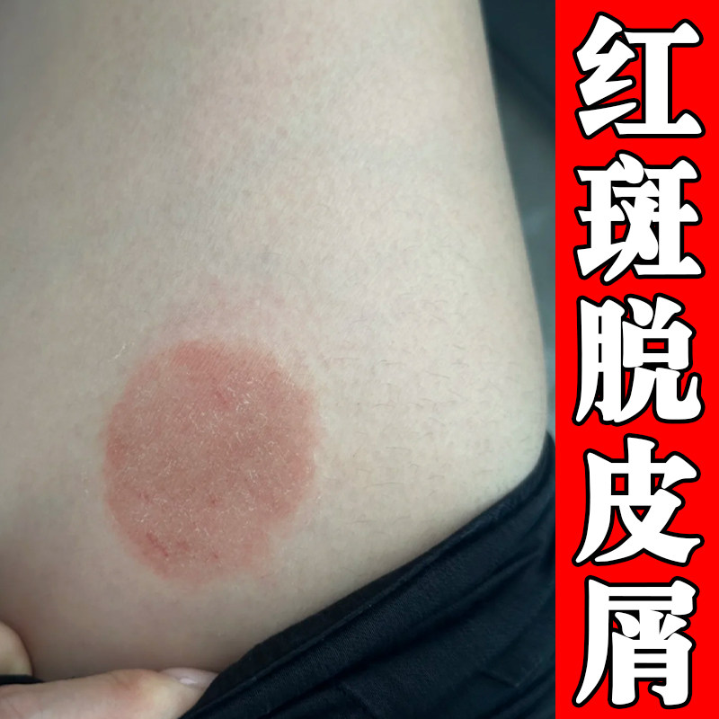 皮肤痒红斑脱皮屑真菌大腿内侧痒膏长小疙瘩小腿干燥粗糙痒外用药