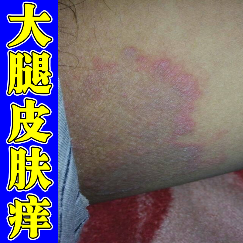 大腿皮肤痒起红斑疙瘩干燥粗糙起皮屑真菌私处阴囊潮湿外用修复膏