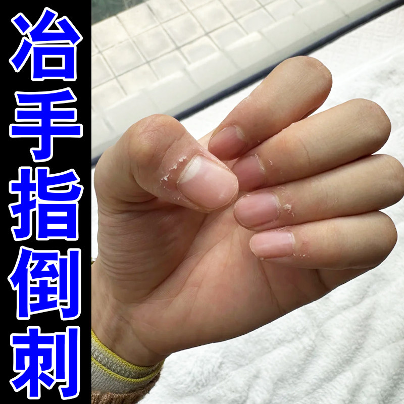 冶手指倒刺去死皮专用软膏指甲边缘干裂脱皮干燥粗糙季节性手倒刺
