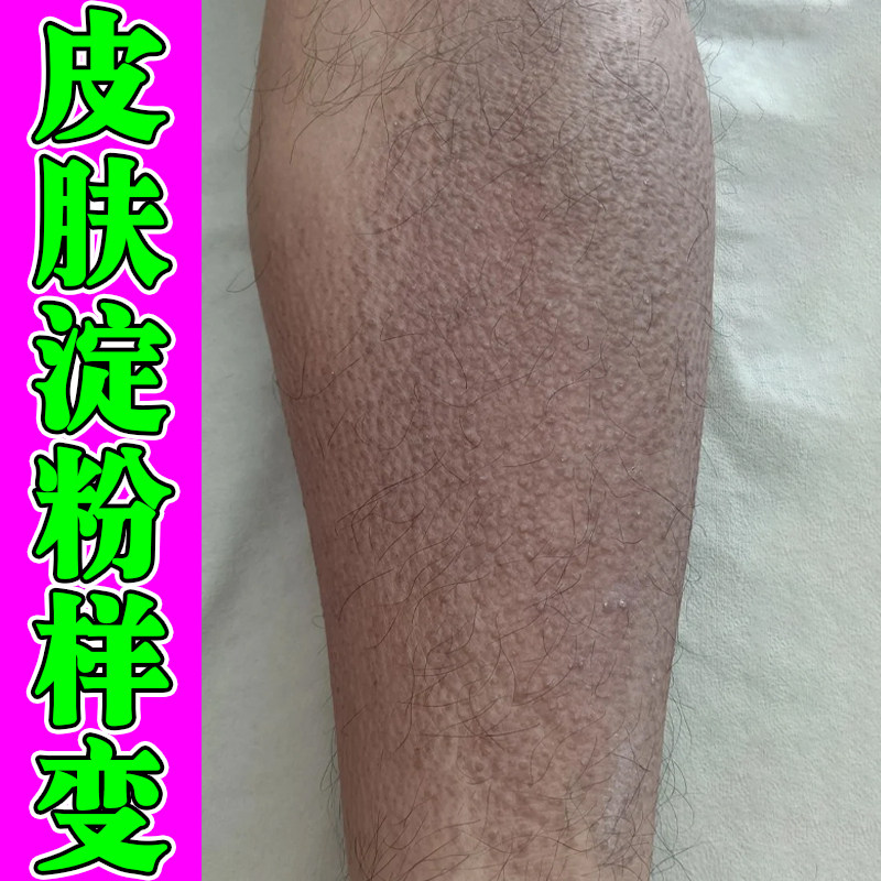 皮肤小疙瘩斑状颗粒摸起来很粗糙痒小腿干燥丘长苔斑疙瘩蛋白沉积