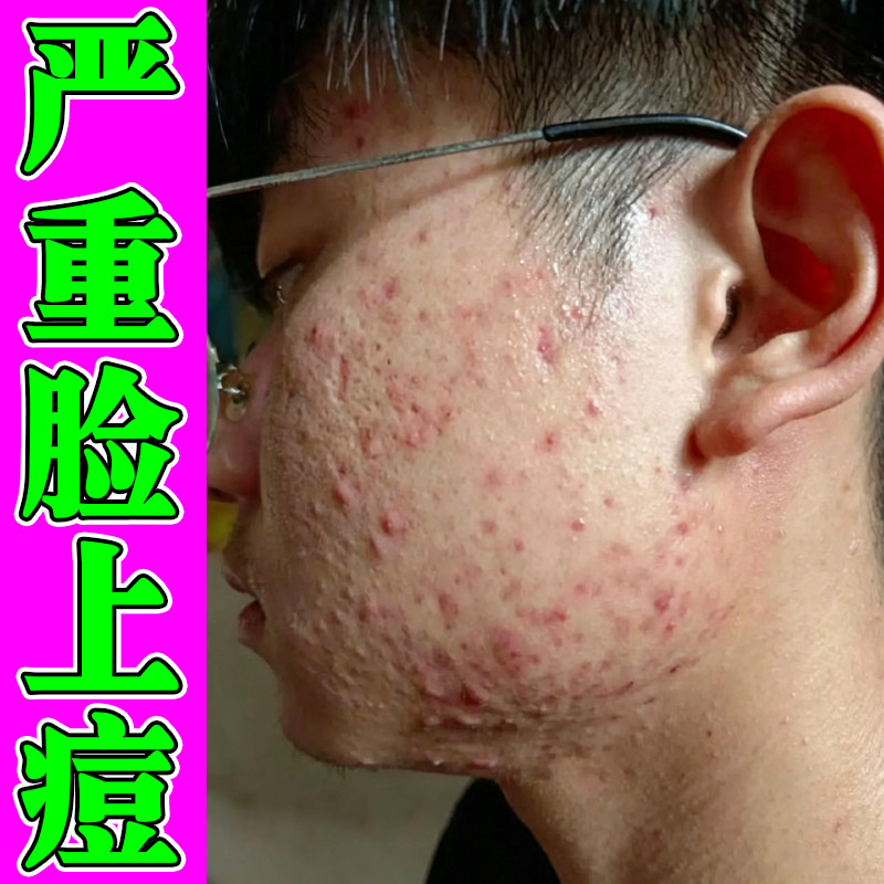 严重脸上痘满脸红肿硬块脓包痘熬夜上火青春期学生脸颊起痘痘乳膏