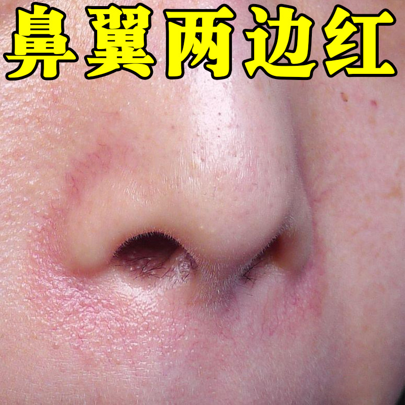 鼻翼两侧红有红血丝修复鼻子两边泛红干燥粗糙长小疙瘩掉皮屑专用